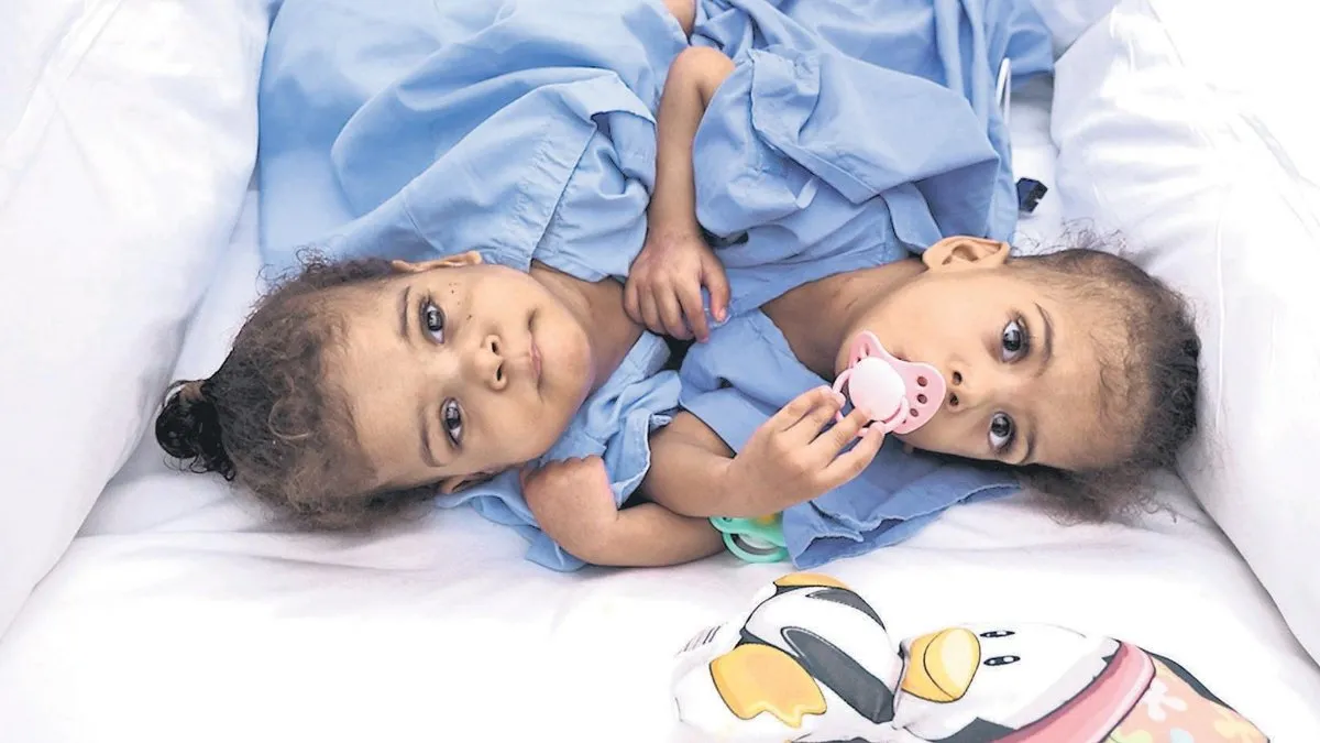 Kalpten bağlı ikızlere muhteşem operasyon